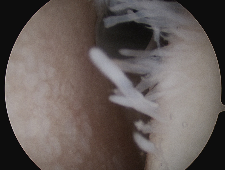 Shoulder OA Glenoid